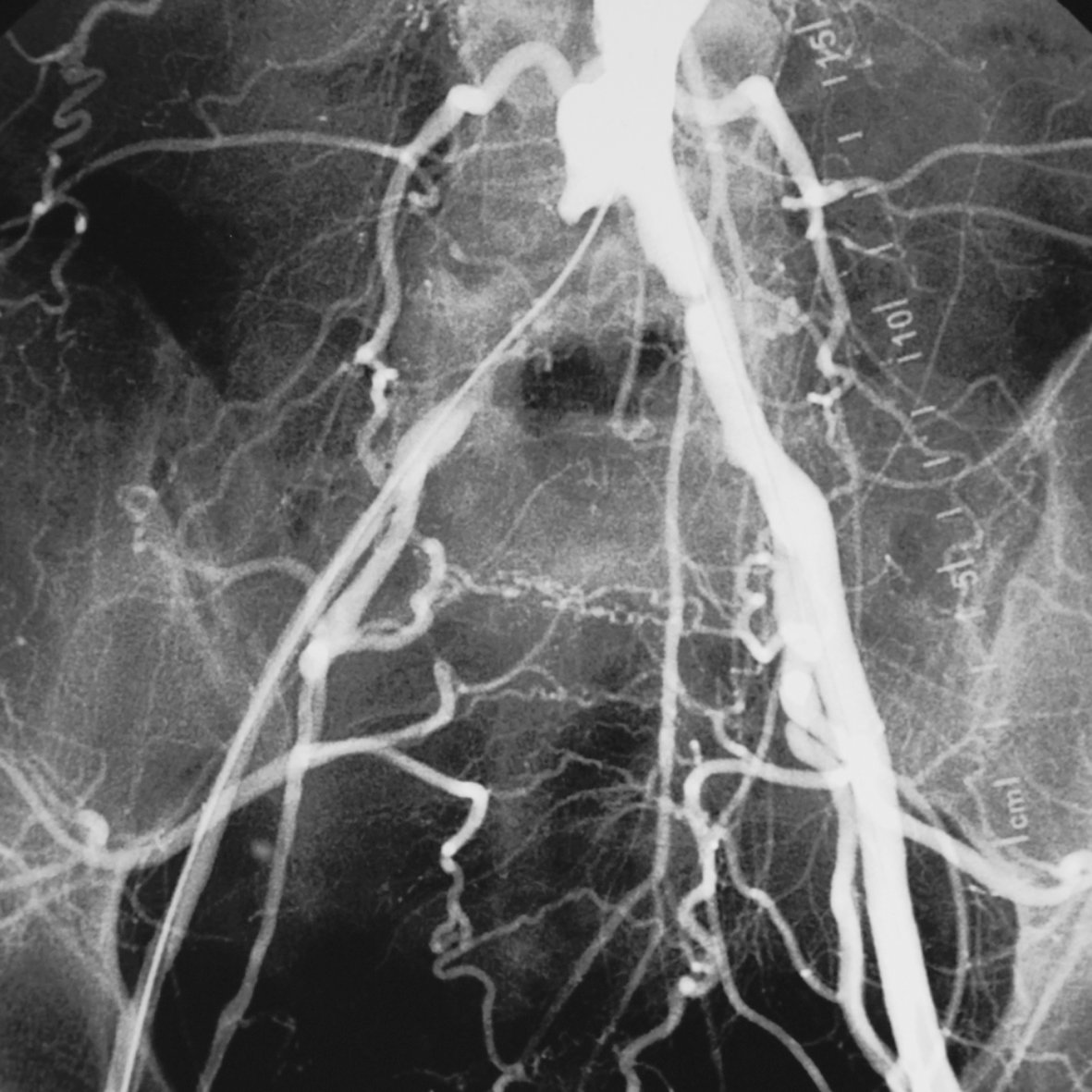 Phlebographie, Radiologie
