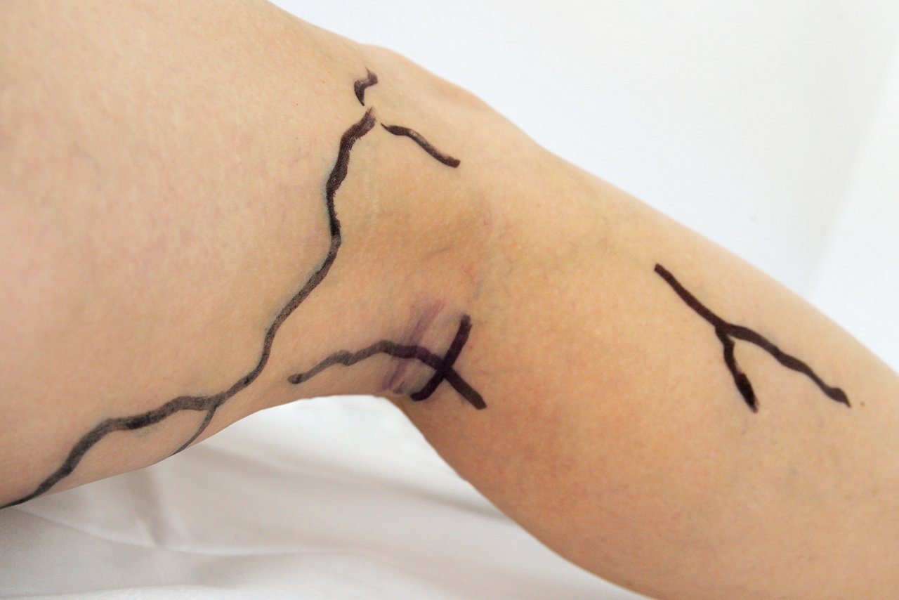 Angezeichnete Krampfadern am Bein eines Patienten