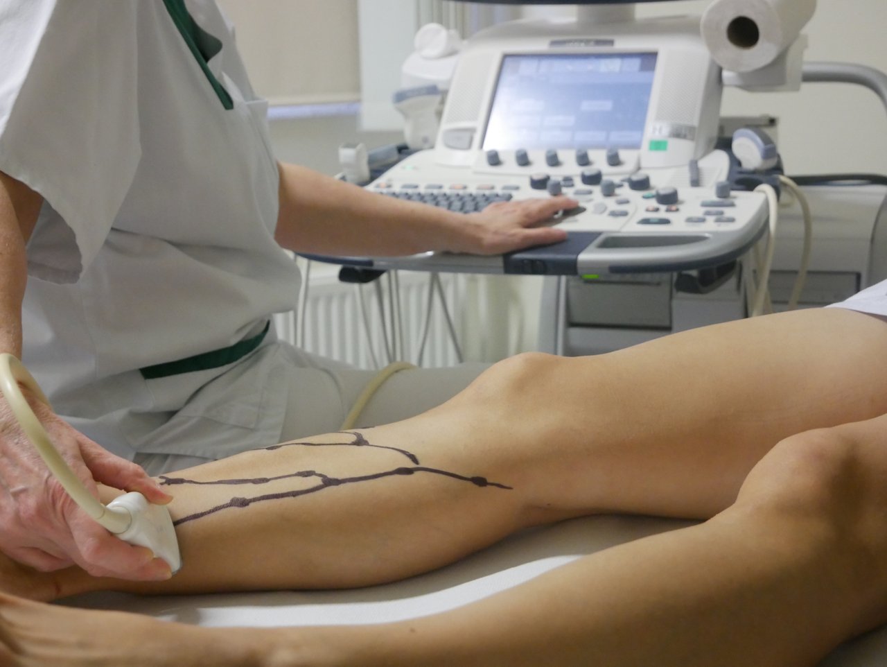 Krampfaderscreening der Beine eines Patienten  