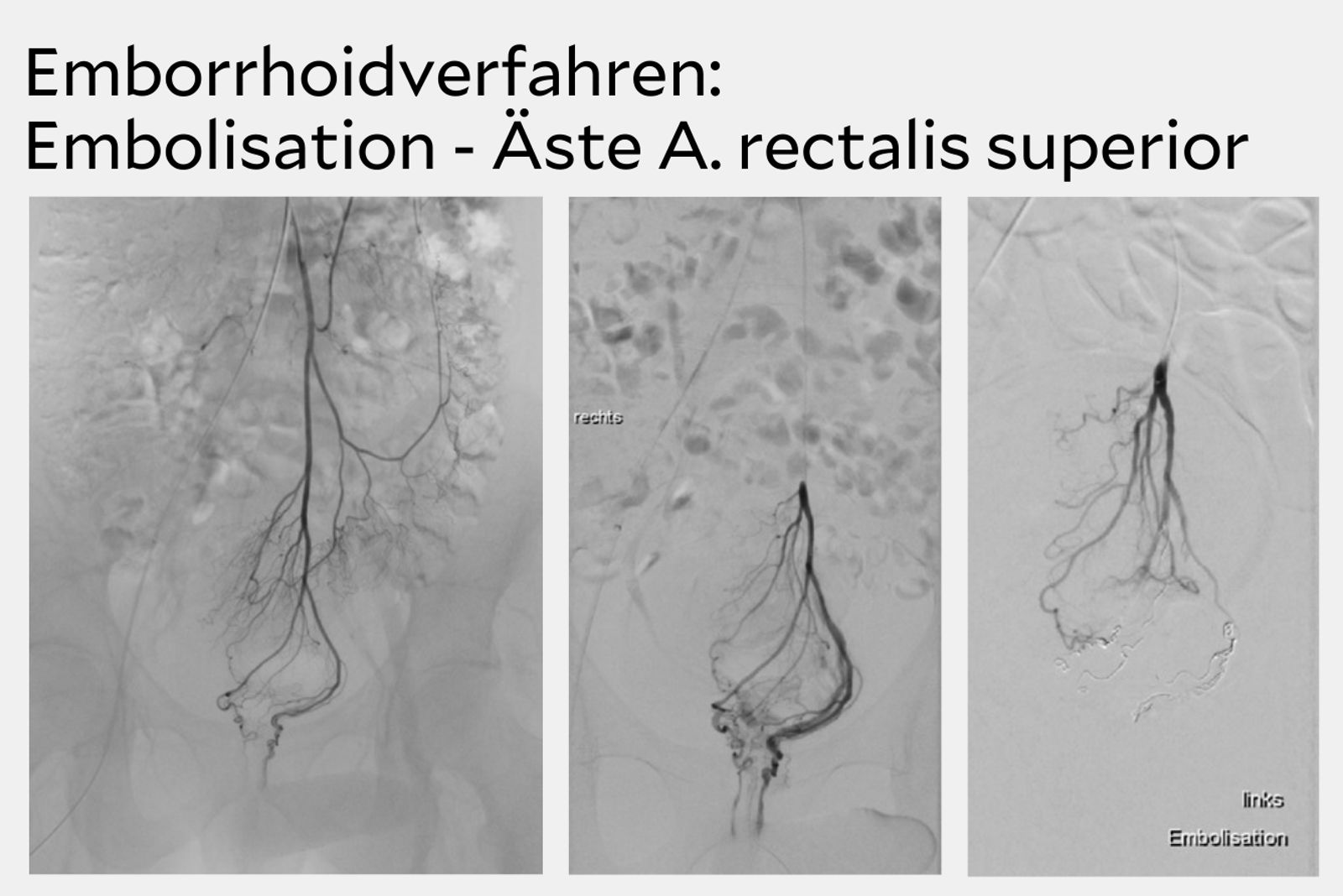 Emborrhoidverfahren