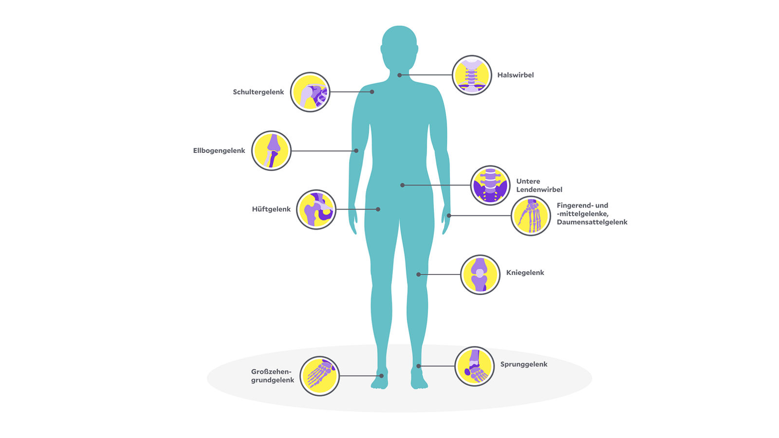 Illustration: an diesen Gelenken kann Arthrose auftreten