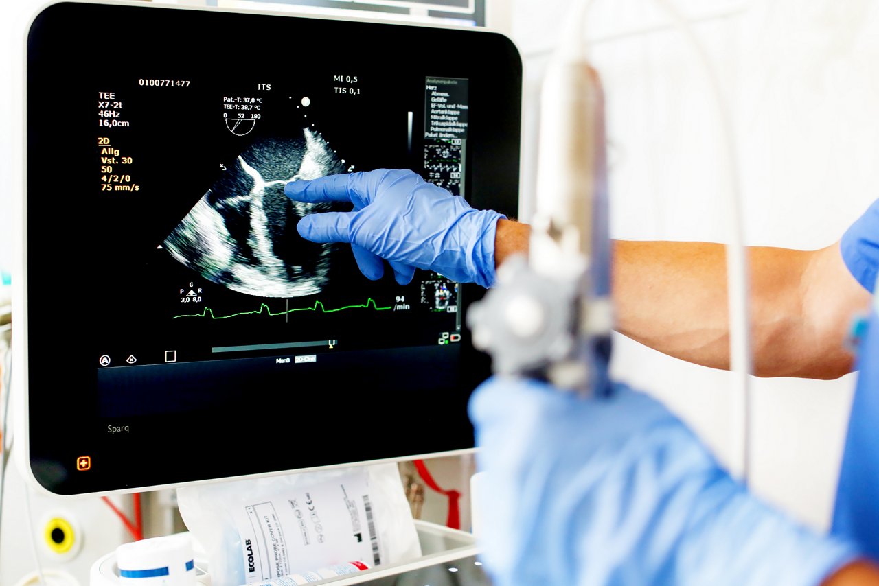 Arzt oder Ärztin zeigt auf den Monitor des Ultraschallgerätes während der TEE-Untersuchung und hält in der anderen Hand die endoskopische Sonde