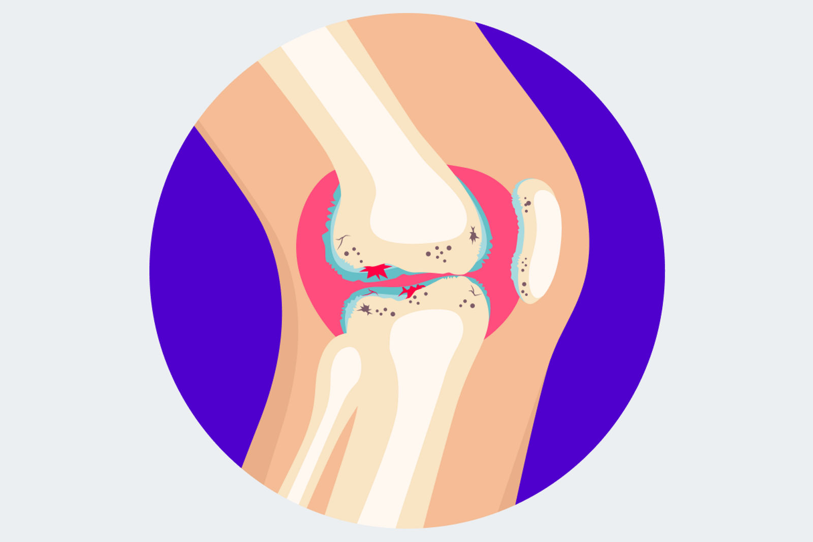 Kniearthrose – Grad 4: Schwerste arthrotische Veränderungen und Schäden deutlich. Der Knorpel fehlt stellenweise vollständig und der darunterliegende Knochen liegt frei.