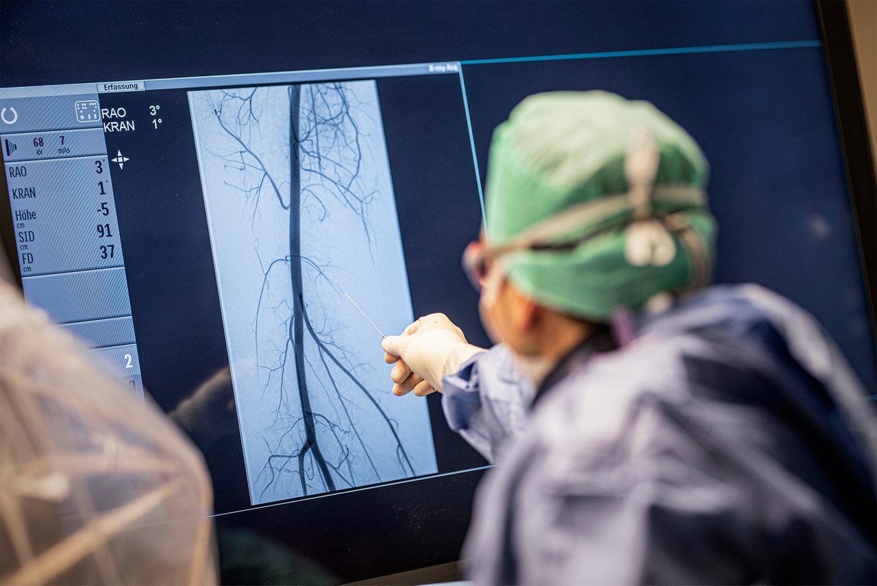 Bild eines Radiologen, der vor einer Gelenkembolisation die Gefäßstruktur eines Knies auswertet.
