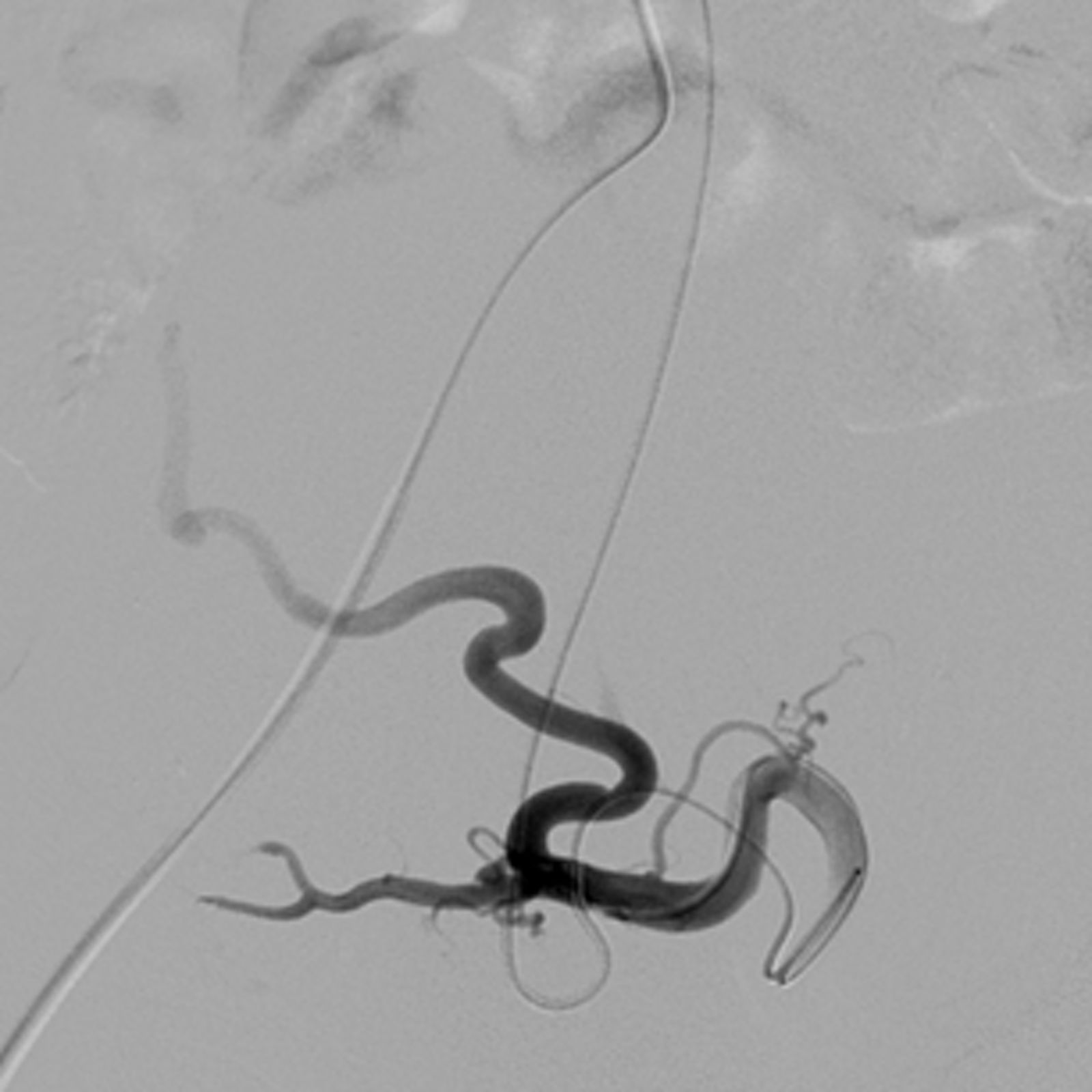 Kontrollbild eines Myoms nach erfolgter Embolisation. Aufgrund des reduzierten Blutzufluss kommt es zu einer deutlichen Schrumpfung des Myoms mit Abnahme der Beschwerden.