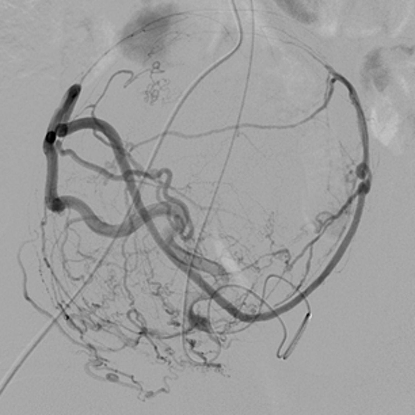 Darstellung eines stark durchbluteten Myoms mit Beschwerden für die Patientin.