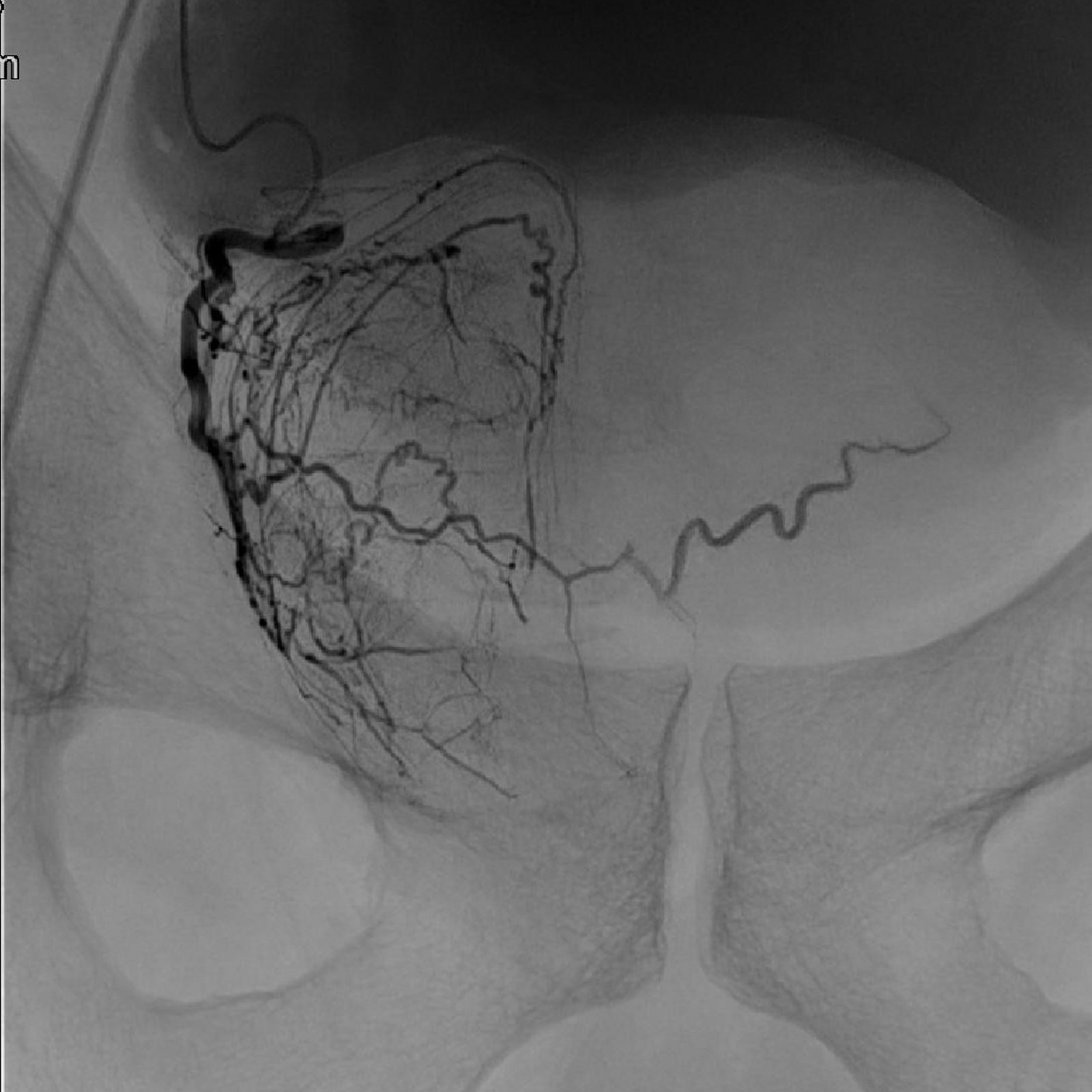 Status der Prostata Durchblutung vor Embolisation