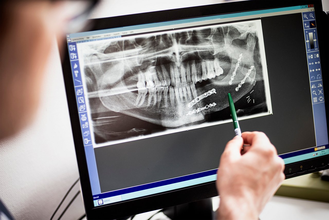 Arzt zeigt auf dem Röntgenbild eines Kiefers eine Verplattung