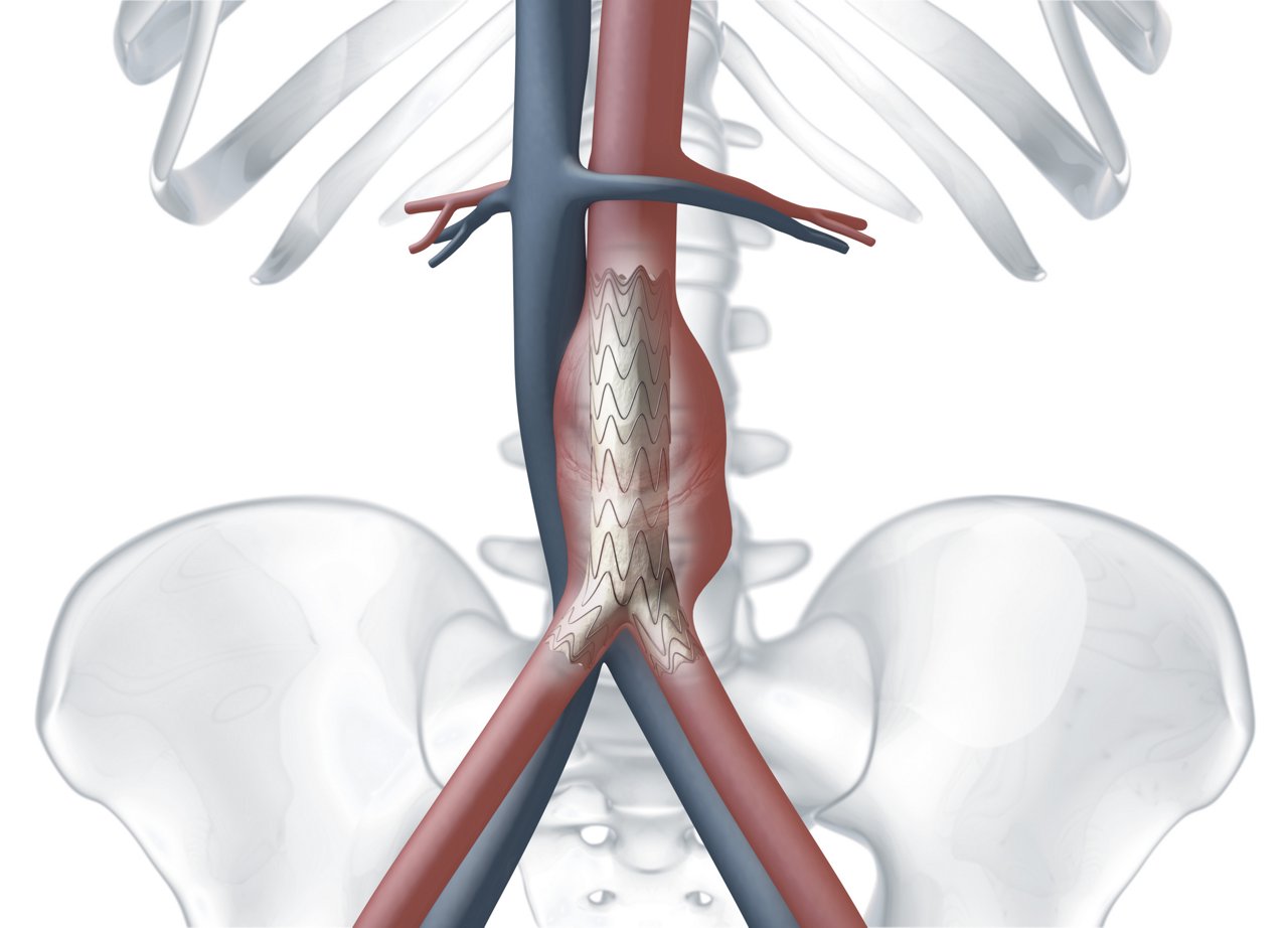 Aorta Aneurysma Herzzentrum Leipzig