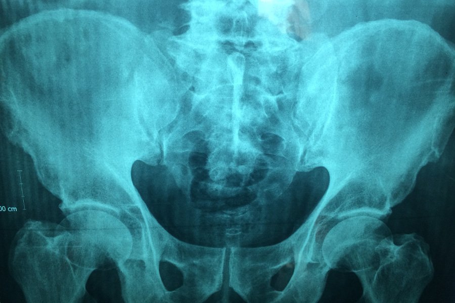 Röntgenfoto von einem Becken