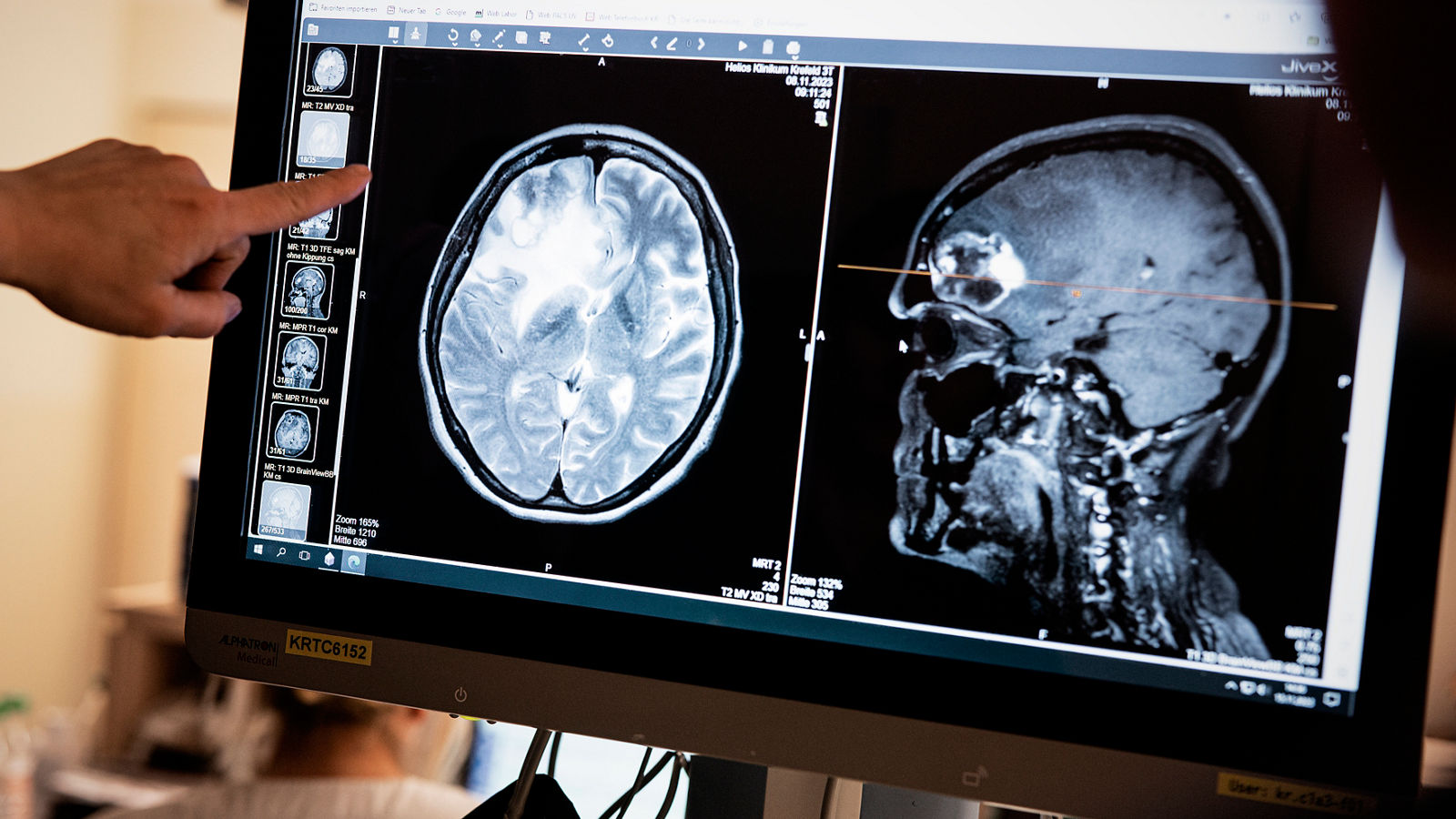 Gehirn CT Röntgenbild Tumor Neurochirurgie 