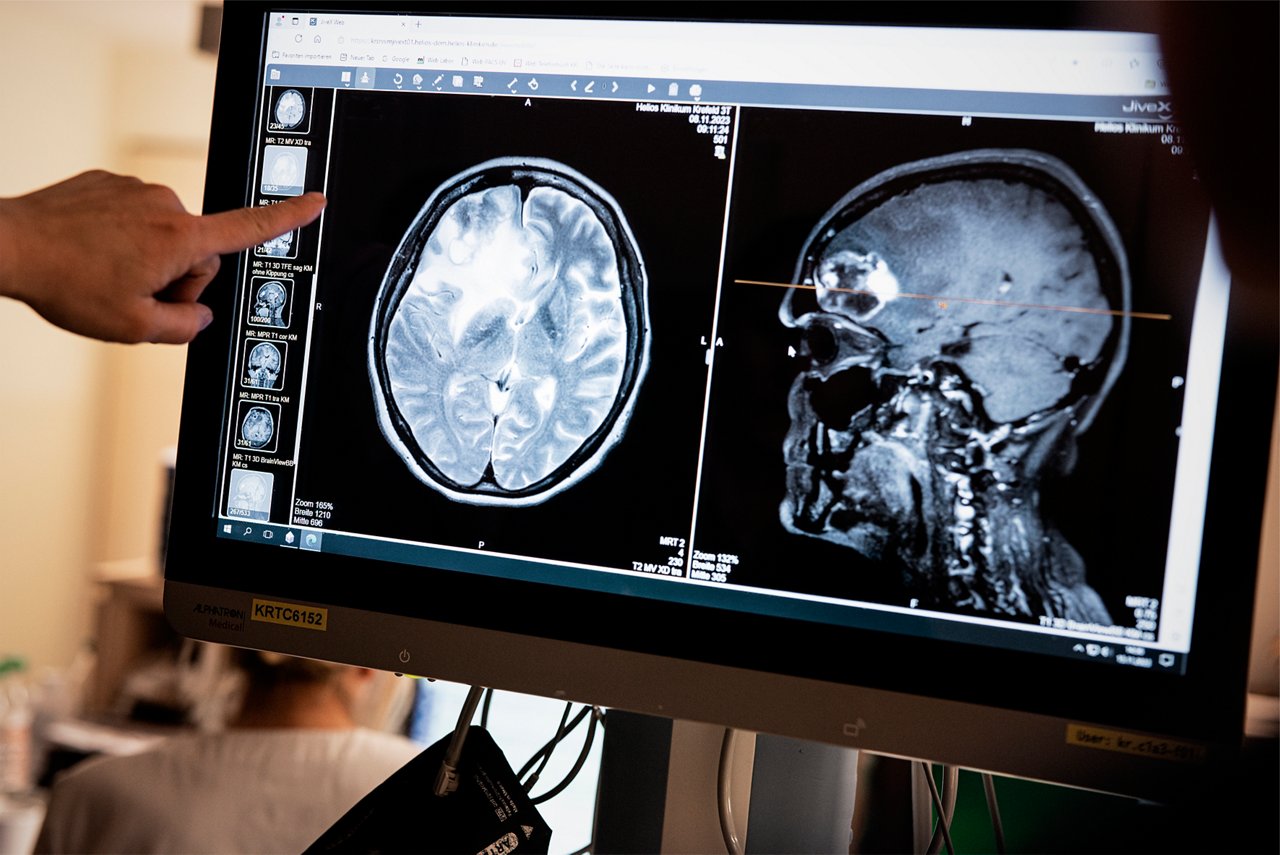 Gehirn CT Röntgenbild Tumor Neurochirurgie 