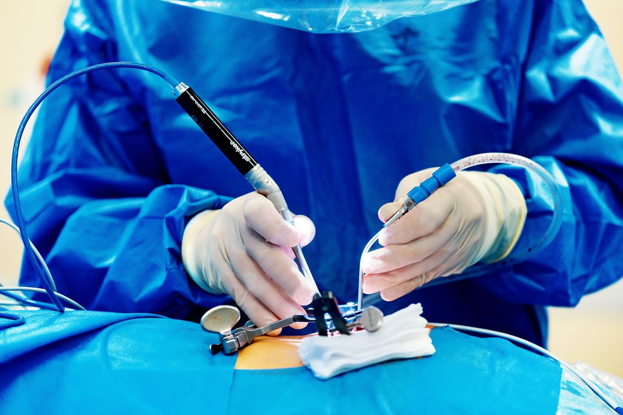 Nahaufnahme Wirbelsäulenoperation