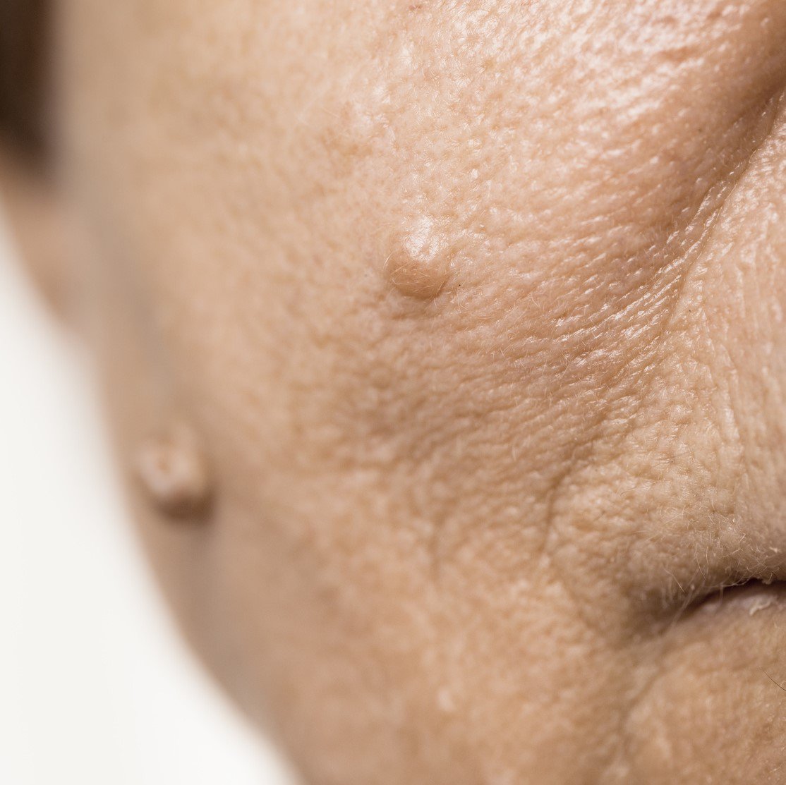 Details of senior woman face. Elderly pensioner female, dermal fibroma close up.