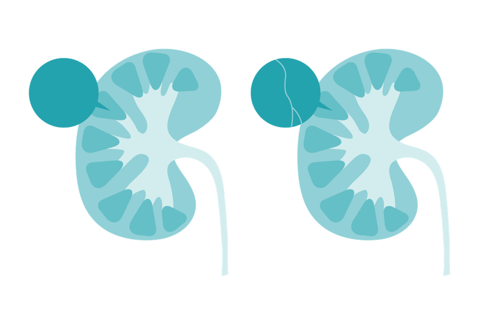 Zwei Illustrationen der Niere, links von einer Niere in der Klassifikation Bosniak I und rechts mit einer Niere der Klassifikation Bosniak II 