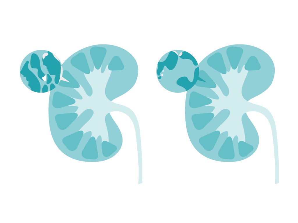 Nierenzysten: Für Bosniak III (links) sowie Bosniak IV (rechts) ist eine operative Entfernung angezeigt