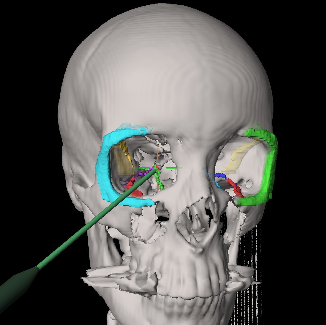 Darstellung navigierte Chrirurgie in der MKG