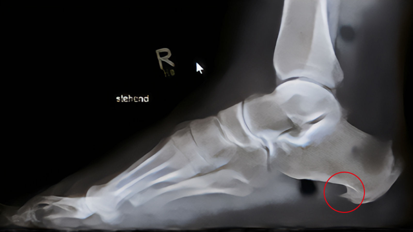 Seitliches Röntgenbild eines Fußes mit Fersensporn 