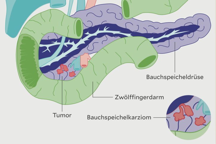 Grafiken Tumorarten