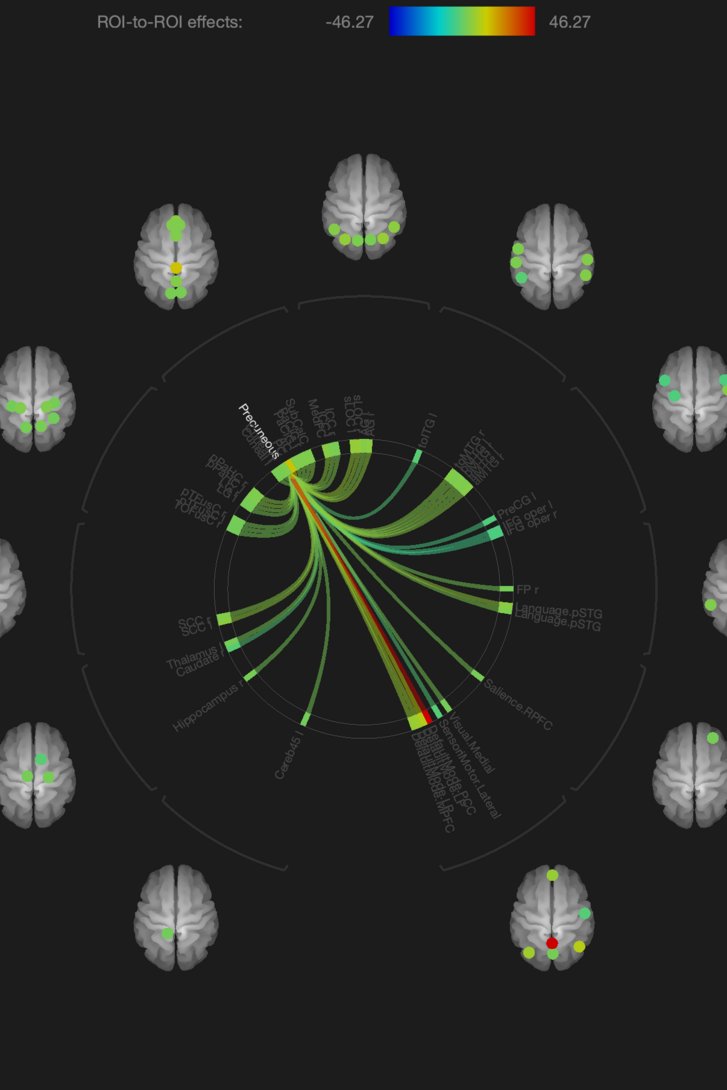 Graphische Darstellung der funktionellen Konnektivität zwischen einzelnen Hirnregionen
