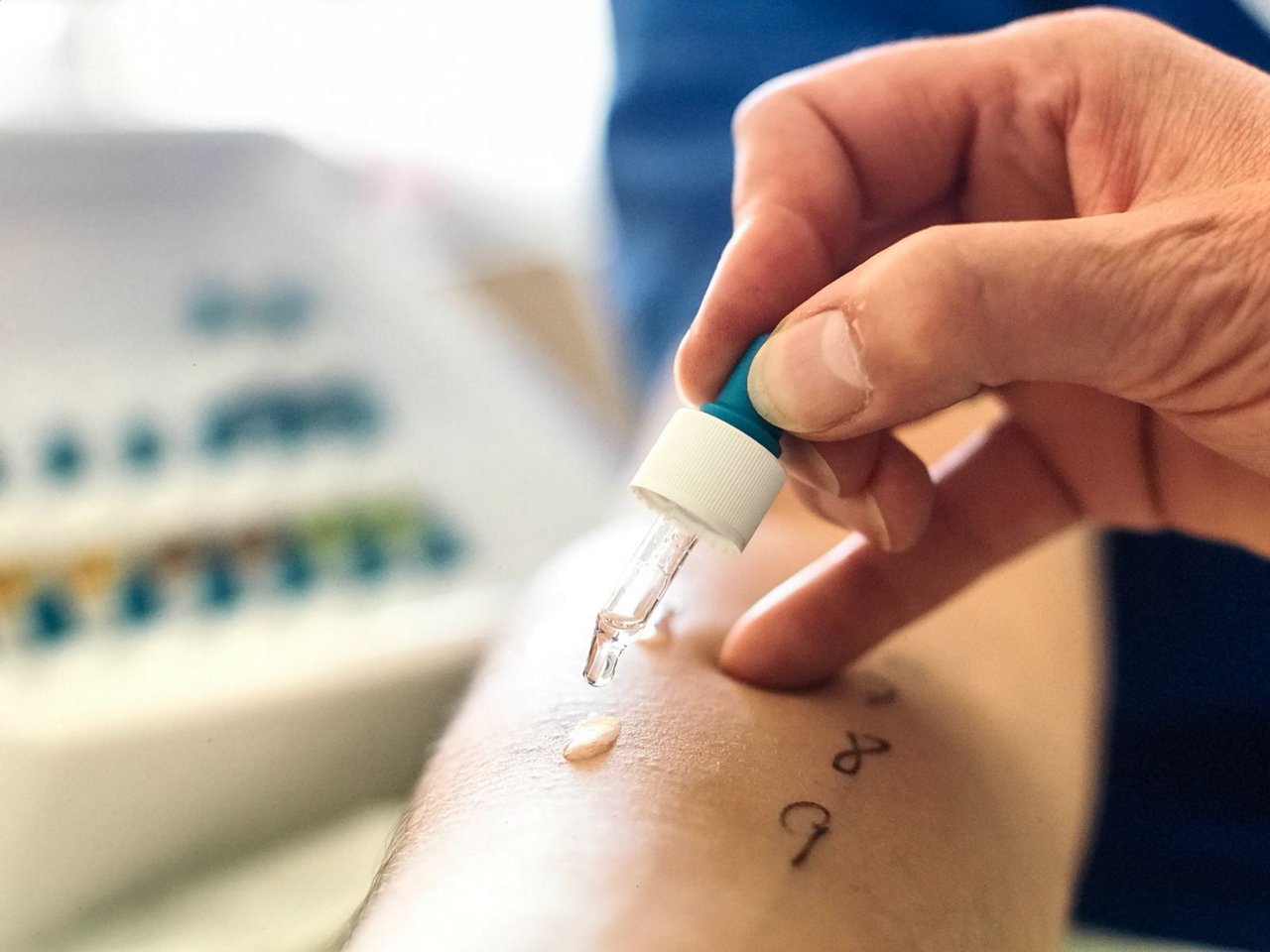 Allergietest am Arm in der Abteilung für Dermatologie am Helios Universitätsklinikum Wuppertal