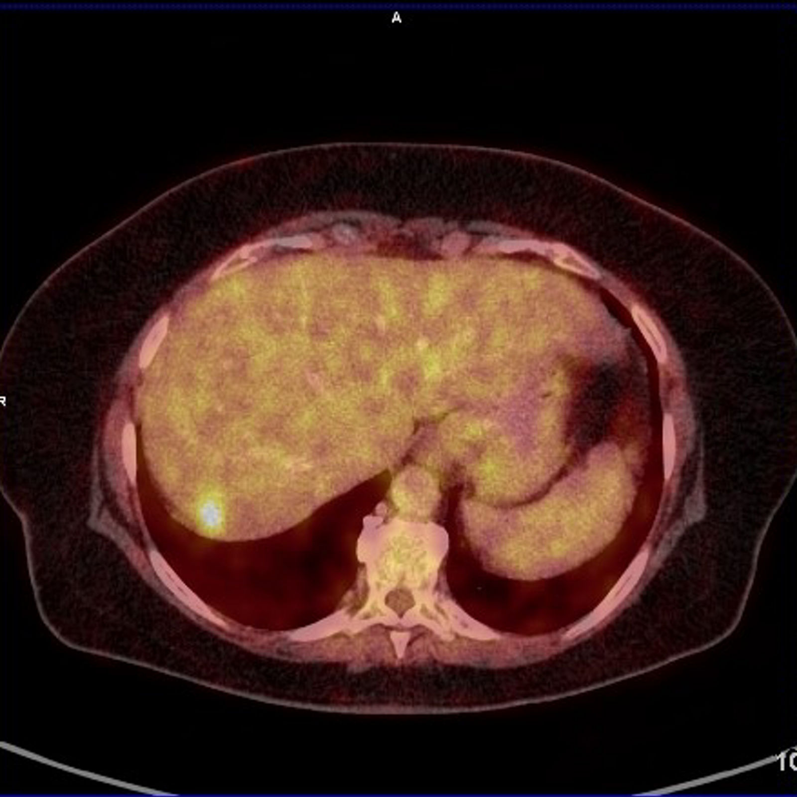 Fusionsbild der Leber