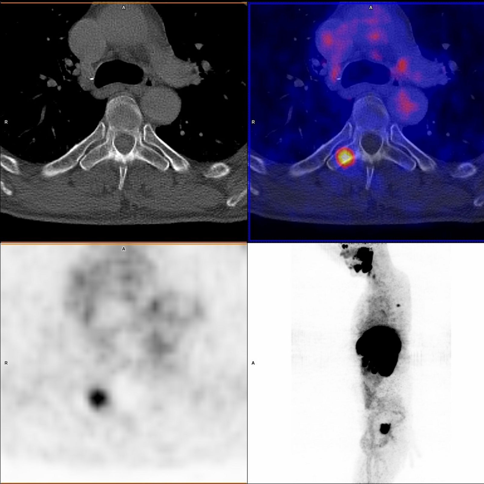 PSMA Knochenmetastase Wirbelkörper Bild 1