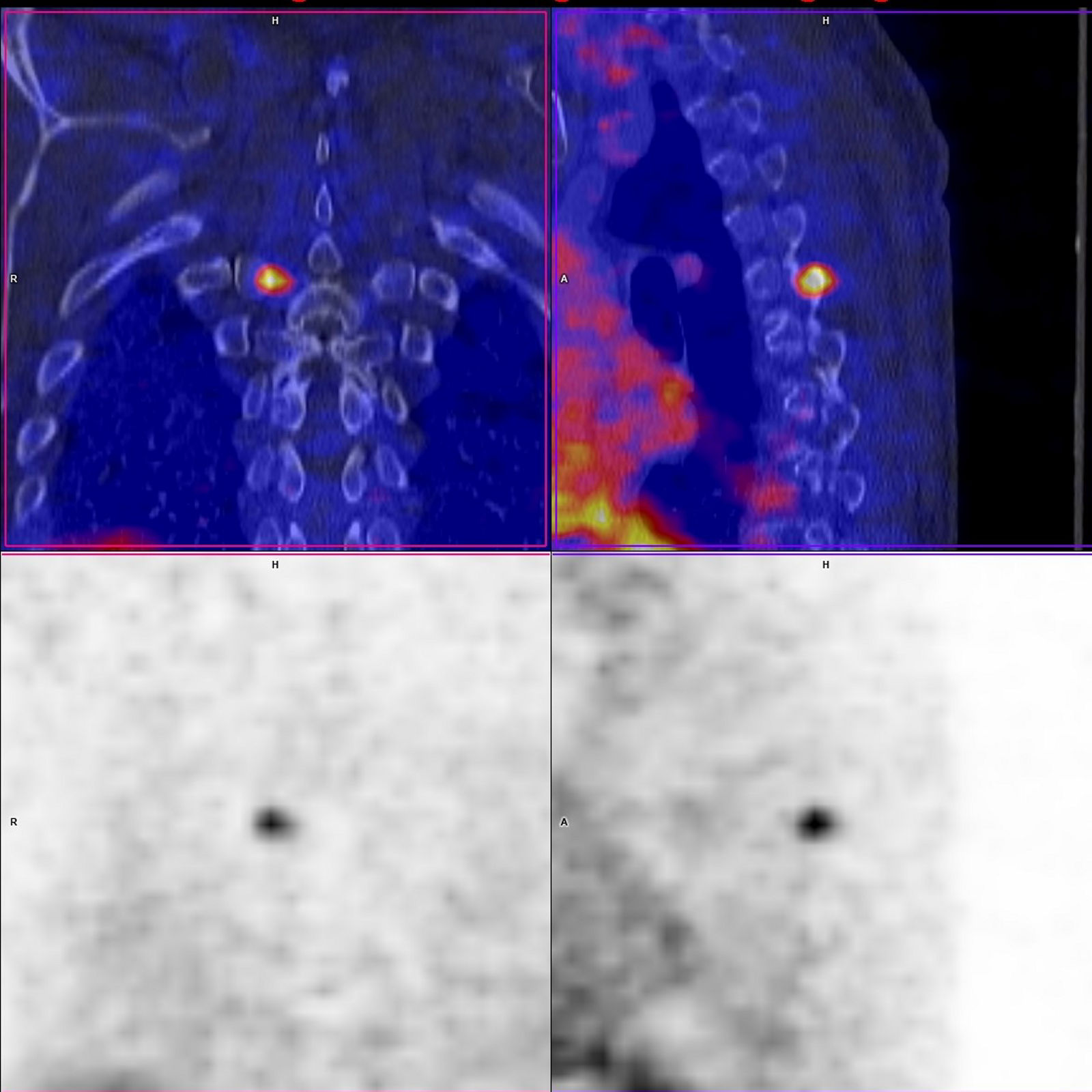 PSMA Knochenmetastase Wirbelkörper Bild 2