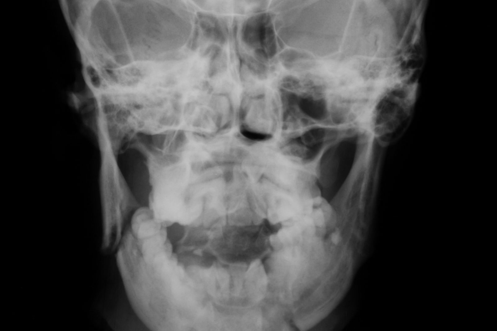 X-ray image of broken skull, AP view, show fracture of mandible.