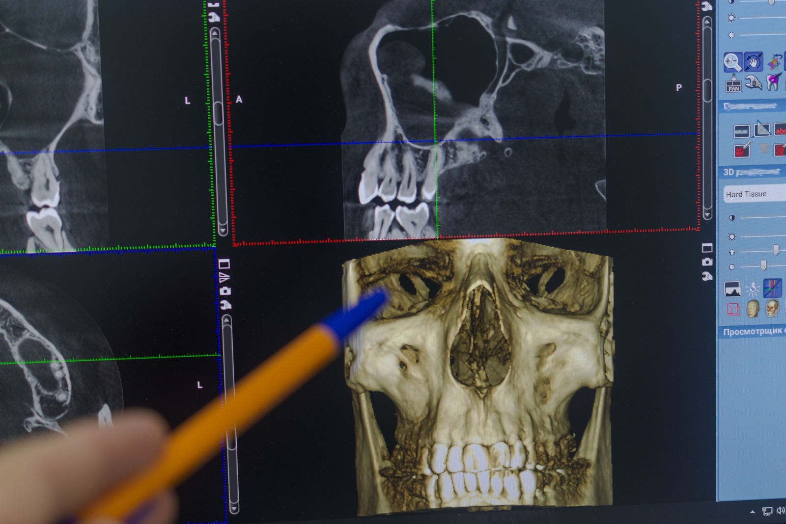 The doctor examines a X-ray examination of the maxillofacial region of the head on a computer monitor. Cone Beam Computed Tomography