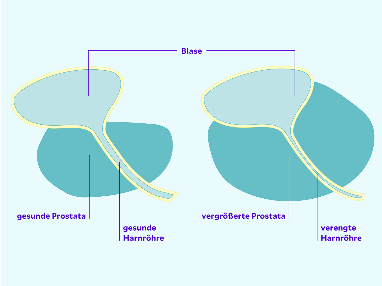 Grafik vergrößerte Prostata