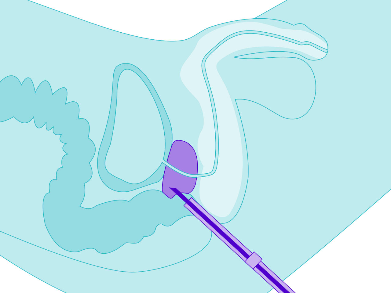 Prostatauntersuchung transrektale Prostatabiopsie