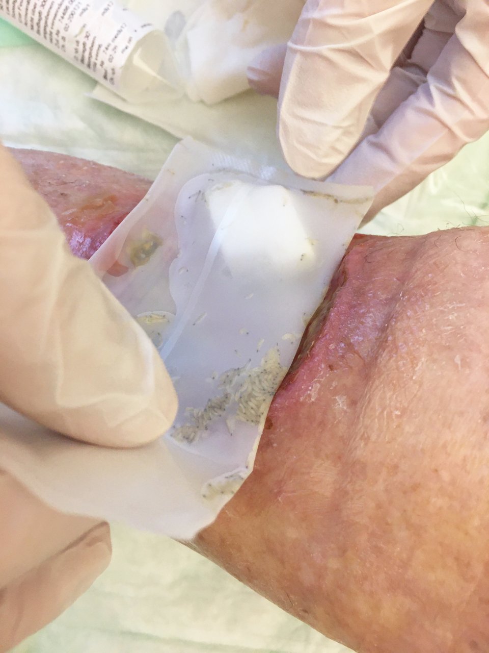 Antikes Verfahren in der modernen Medizin: Maden werden zur natürlichen Wundheilungsförderung angewendet 