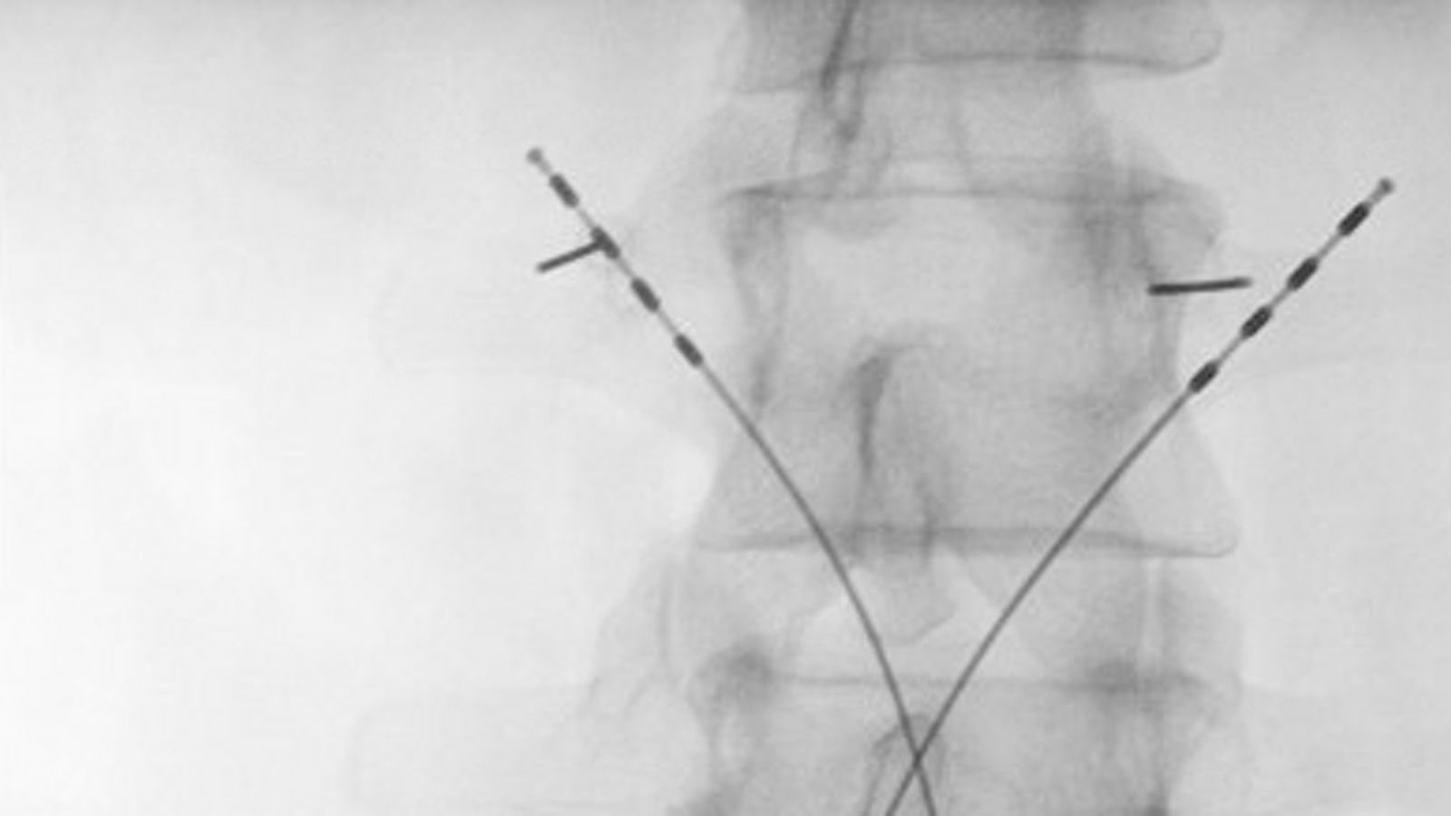 Nienburg als einer der Vorreiter in Deutschland: Bereits 70 Neurostimulatoren zur Regeneration der tiefen Rückenstreckermuskulatur implantiert