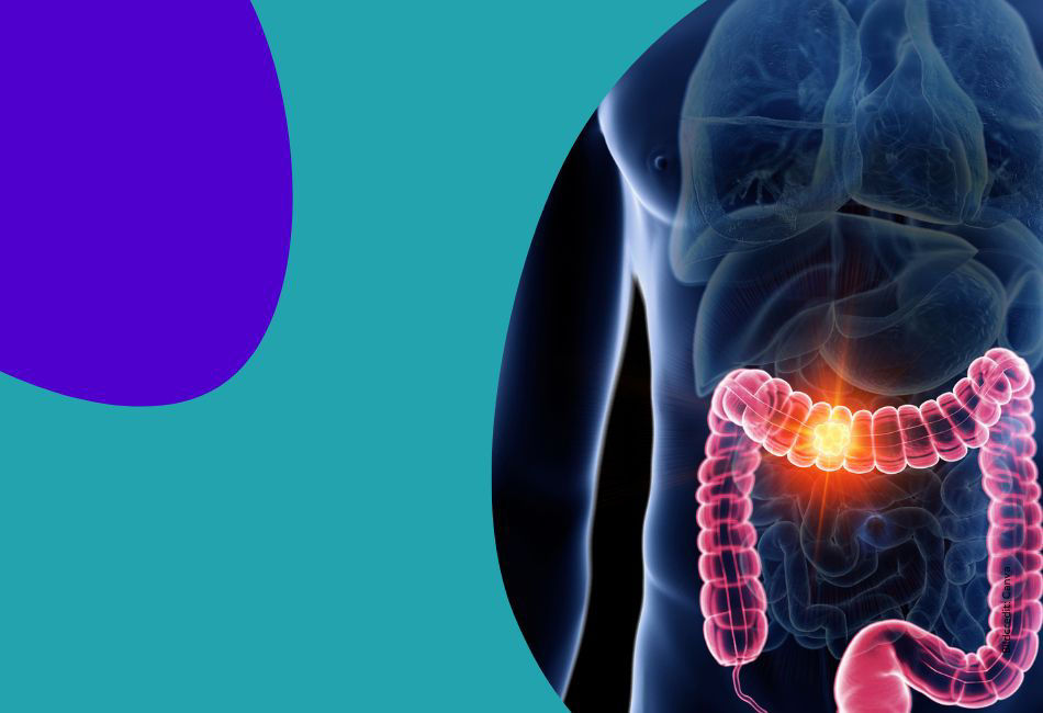 Dickdarmkrebs – Vorsorge rettet Leben 