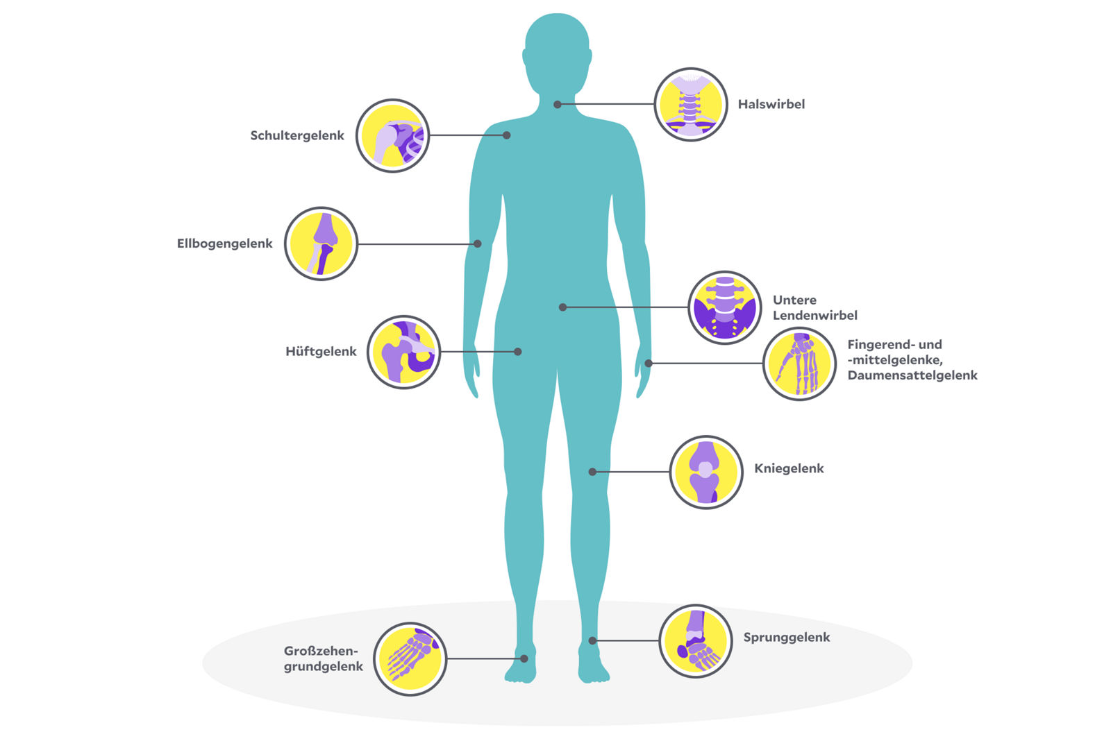 Illustration: an diesen Gelenken kann Arthrose auftreten