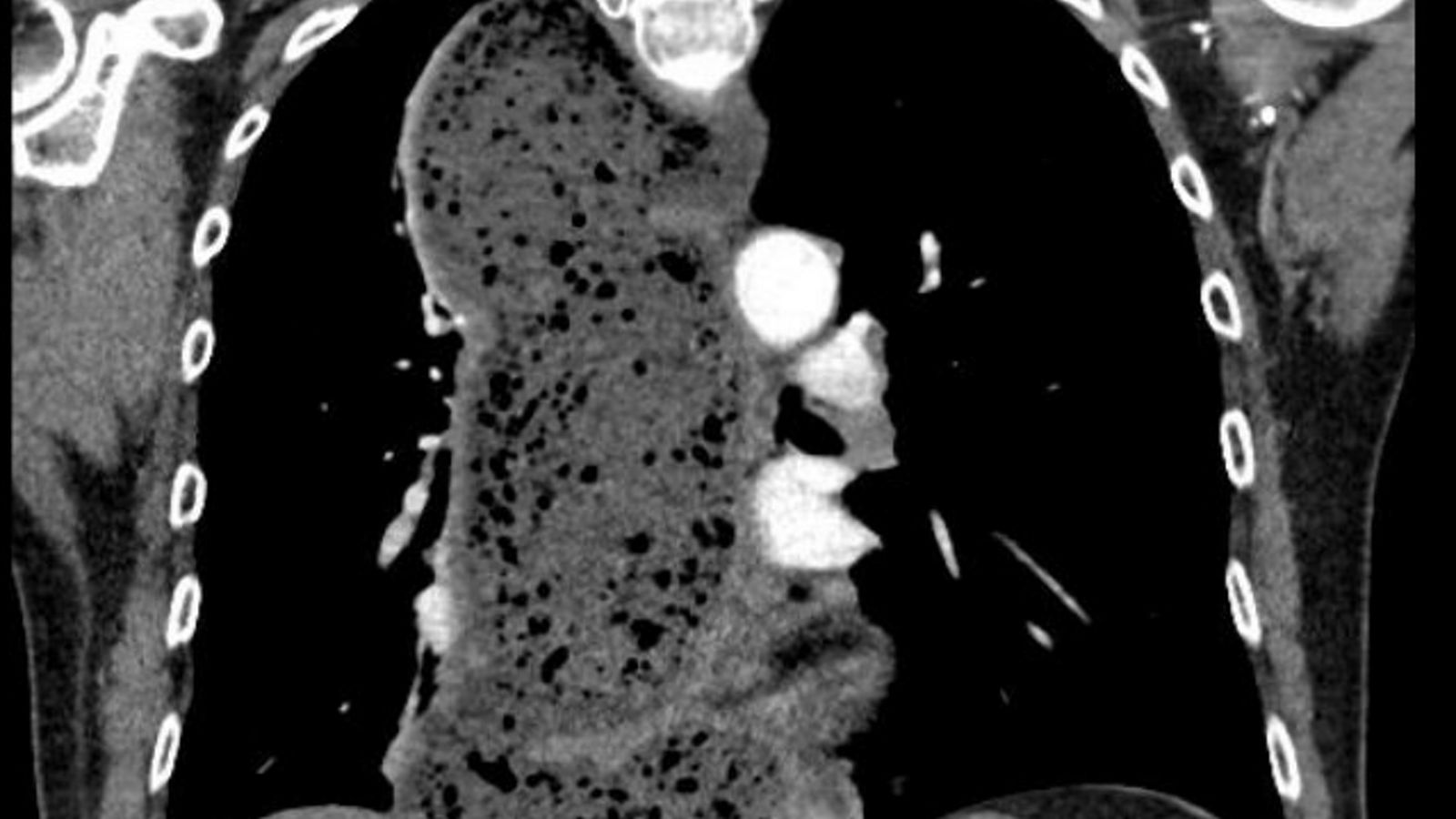 Seltene Diagnose nach jahrelangen Beschwerden: Speiseröhrenbehandlung bringt Lebensqualität zurück 