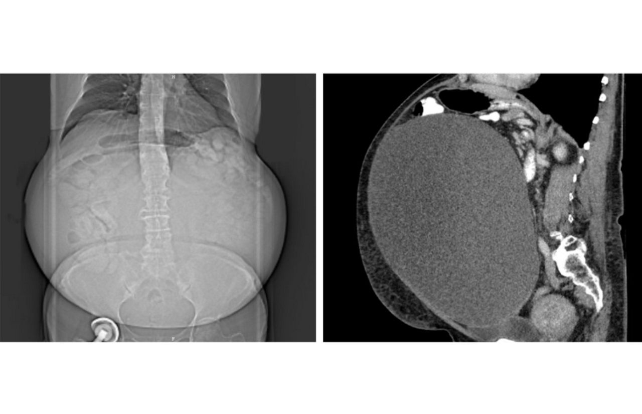 Seltene medizinische Ausnahmefälle: Zweiter übergroßer Eierstocktumor innerhalb von zwei Monaten erfolgreich entfernt