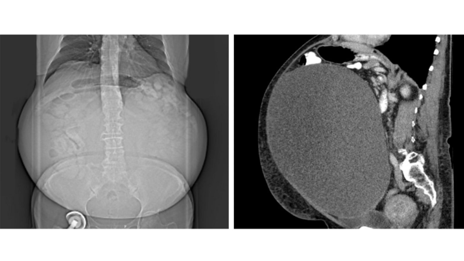 Eierstocktumor Doppelansicht