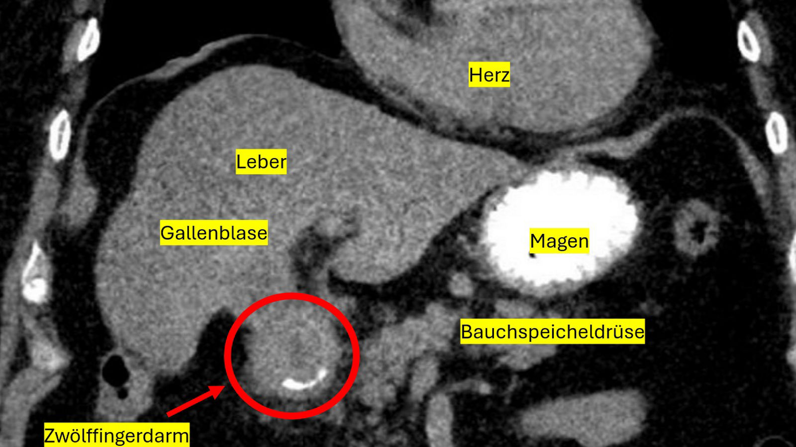 Gallenstein Darm CT-Bild