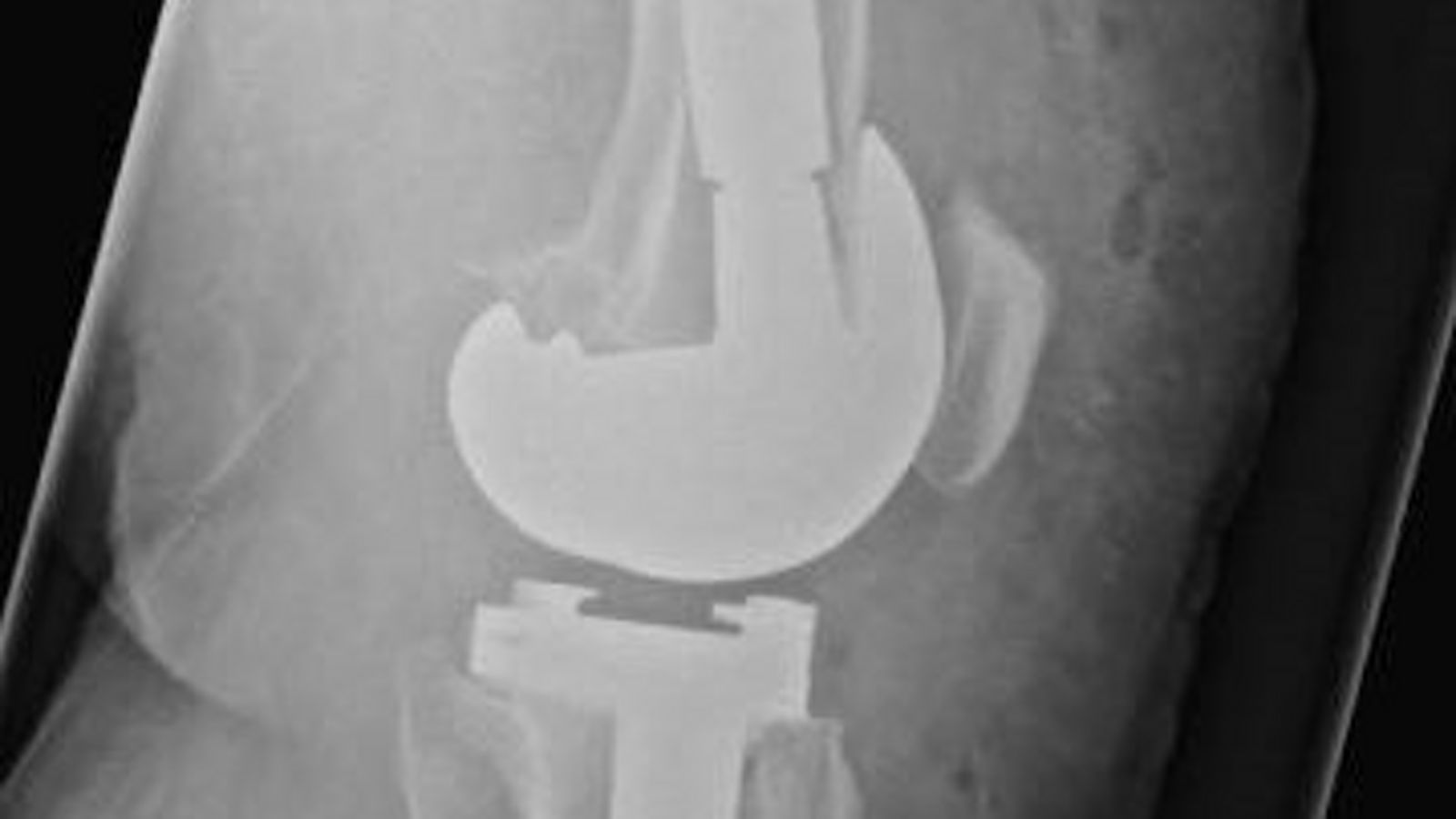 Patientin Prothese Webber-Touray