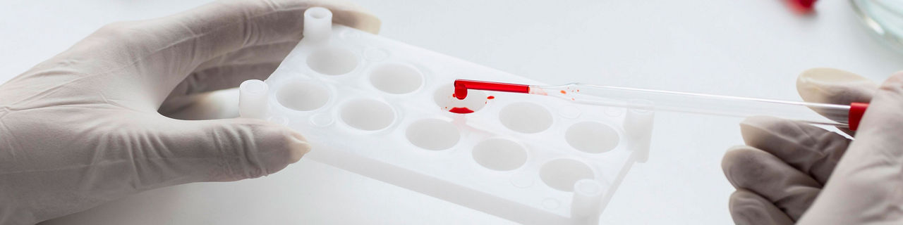 Imagen banner - Análisis de sangre para detectar ADN tumoral en fases tempranas