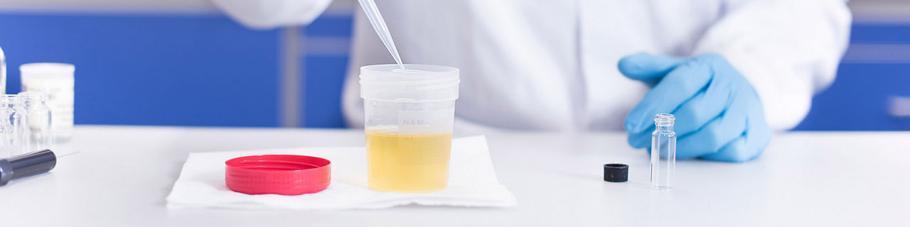 Investigador en un laboratorio analizando una muestra de orina como parte de un estudio sobre biomarcadores para la detección precoz del cáncer de vejiga.
