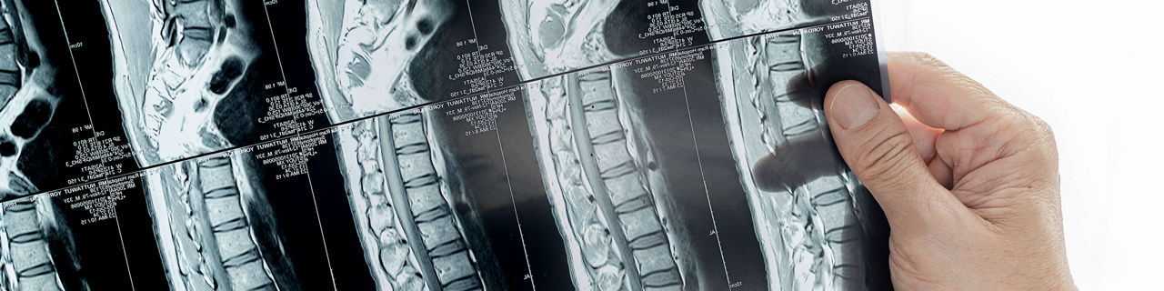 Resonancia magnética de la columna vertebral, imagen relacionada con la regeneración nerviosa tras una lesión