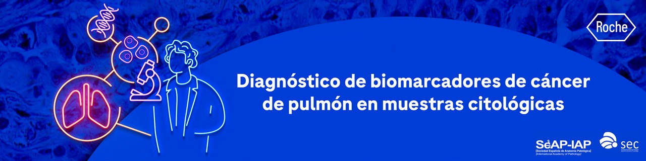 diagnostico-biomarcadores-cancer-pulmon