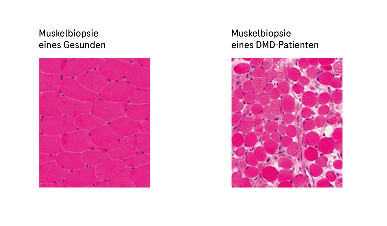 Lichtmikroskopische Fotografien gefärbter Muskelbiopsien eines Gesunden (links) und eines DMD-Patienten (rechts).