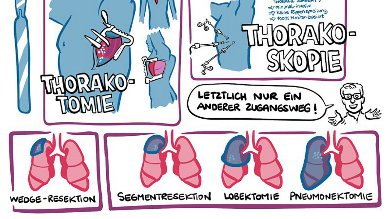 Krebsimmuntherapie beim operablen NSCLC