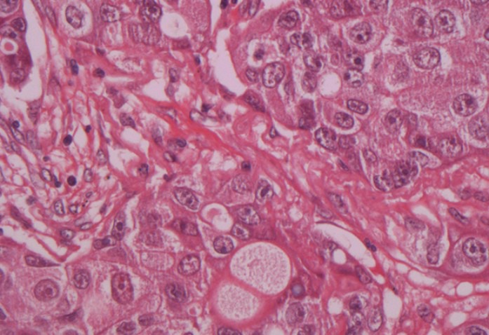 Avastin-In-Cancerul-Pulmonar-image-1