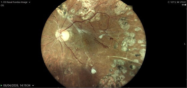  Prikazani snimci predstavljaju primjere nalaza očnog dna zabilježenih fundus kamerom tokom rutinskog teleoftalmološkog skrininga u realnoj kliničkoj praksi