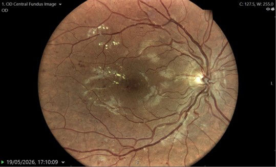  Prikazani snimci predstavljaju primjere nalaza očnog dna zabilježenih fundus kamerom tokom rutinskog teleoftalmološkog skrininga u realnoj kliničkoj praksi
